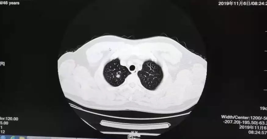 早預(yù)防，早發(fā)現(xiàn)，早治療 | 浩恩健康體檢十一月重大陽性數(shù)據(jù)發(fā)布